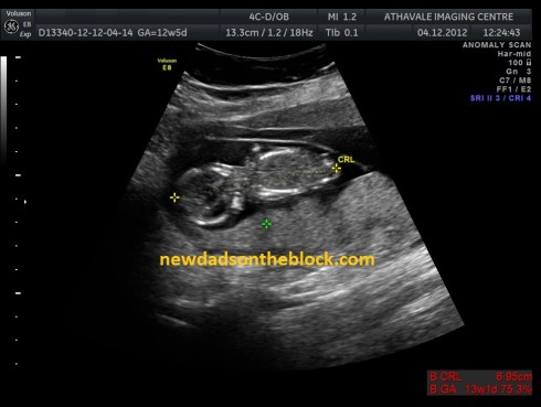 week 12 twelve sonogram baby 2 120412