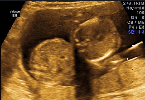 Week 18 twin sonogram new dads on the block